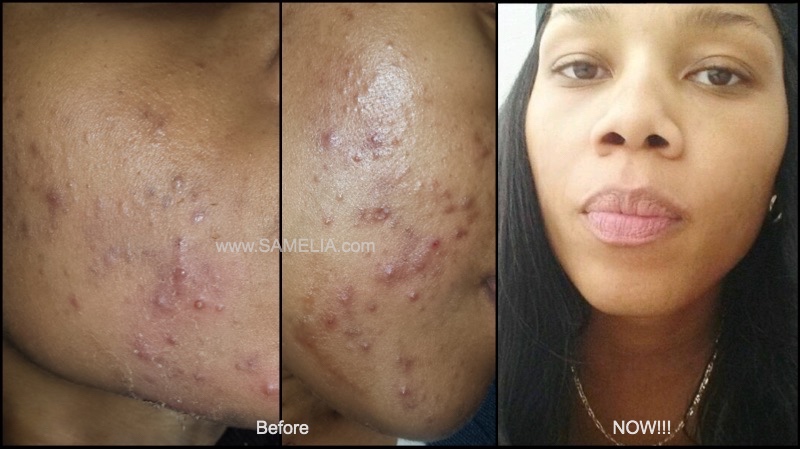 samelia_acne_treatments_facial